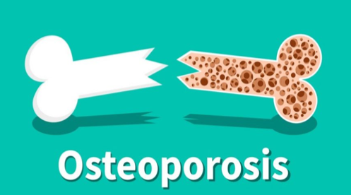 Pencegahan Osteoporosis: Menjaga Tulang Sehat untuk Masa Depan yang Lebih Baik